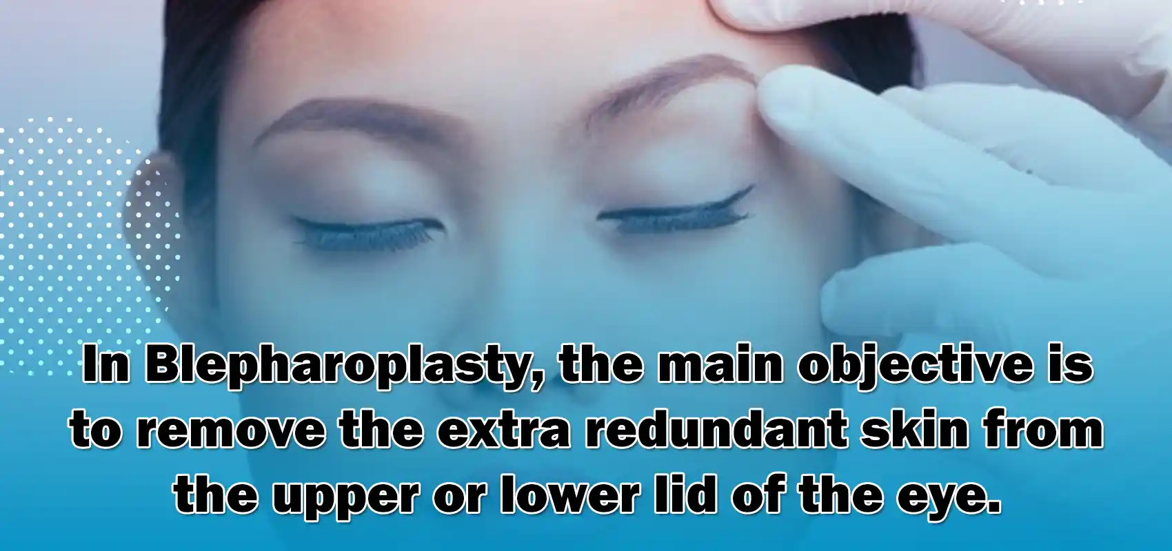 In Blepharoplasty, the main objective is to remove the extra redundant skin from the upper or lower lid of the eye