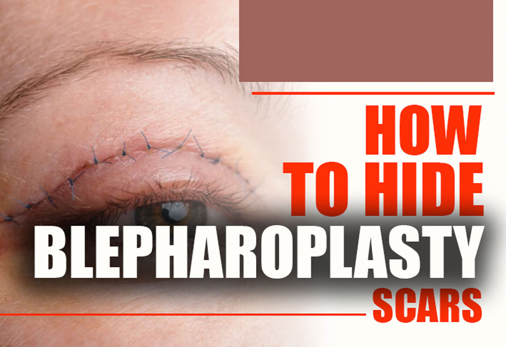 How to Hide Blepharoplasty Scars?