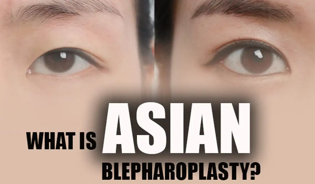 Asian Blepharoplasty is a kind of Blepharoplasty surgery