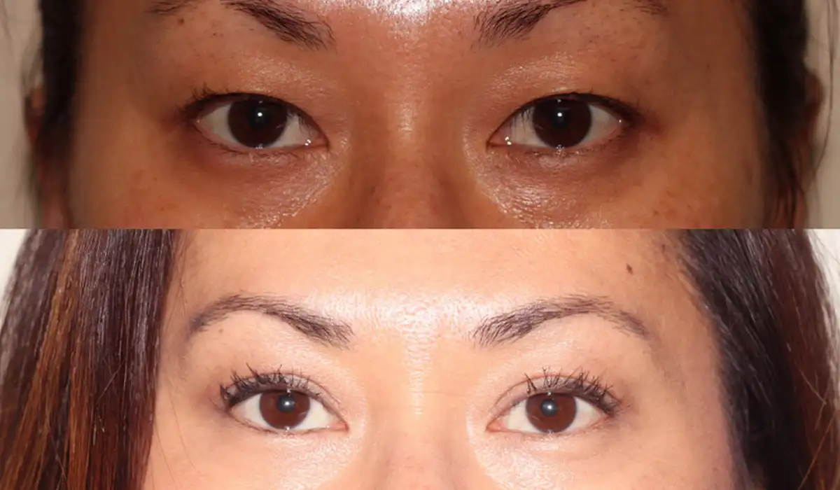 Asian Blepharoplasty is one of the surgeries that gets done on the eyelid