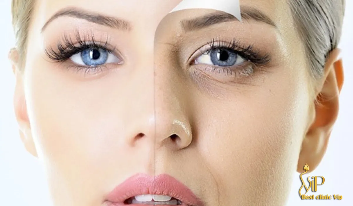 Blepharoplasty surgery is one of the surgeries done on the face, eyelids to be exact