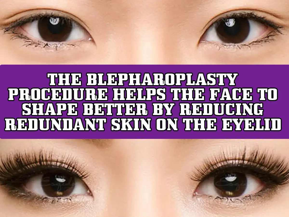 The Blepharoplasty procedure helps the face to shape better by reducing redundant skin on the eyelid