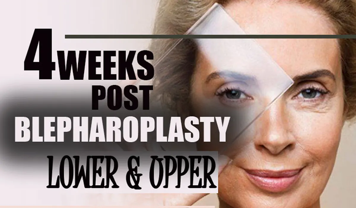 The Blepharoplasty surgery is done on the eye