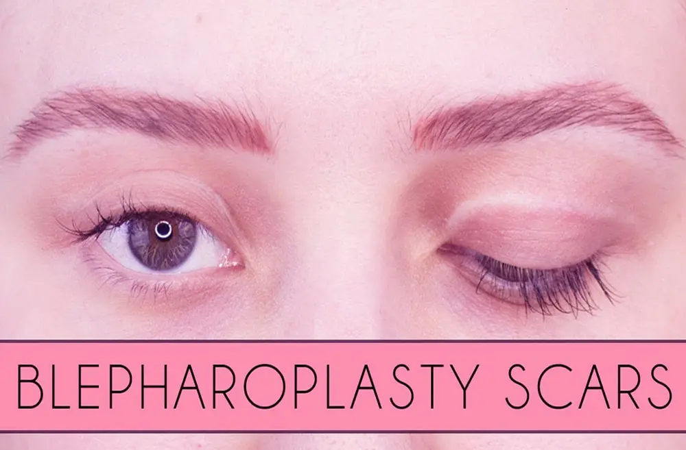Blepharoplasty scars