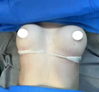 breast implant in Iran
