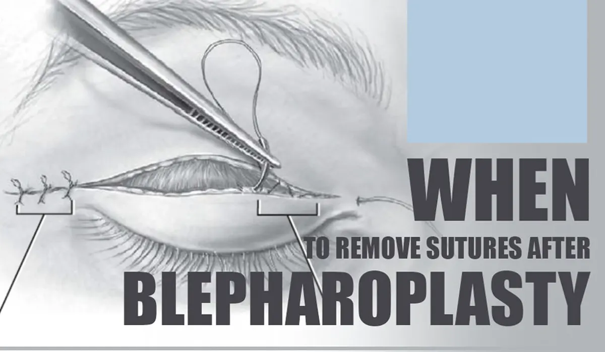 recovery period for Blepharoplasty surgery is up to one year, which is incorrect