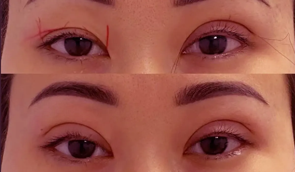 when you should remove the sutures after Blepharoplasty surgery