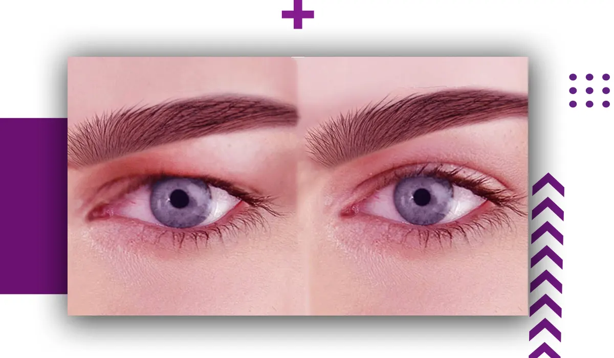 how you can tighten the eyelid skin without Surgery
