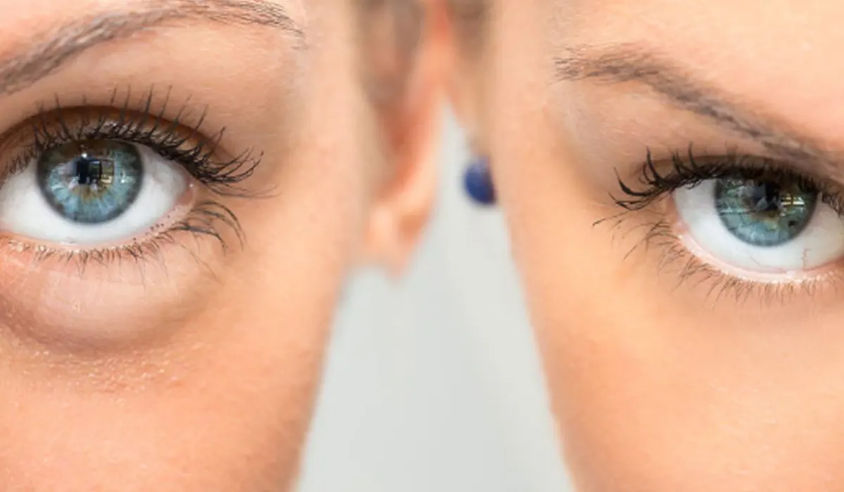 principles of reducing eyelid skin without Surgery