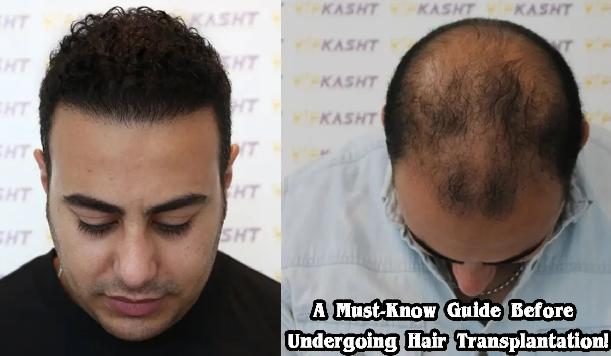 A Must-Know Guide Before Undergoing Hair Transplantation!