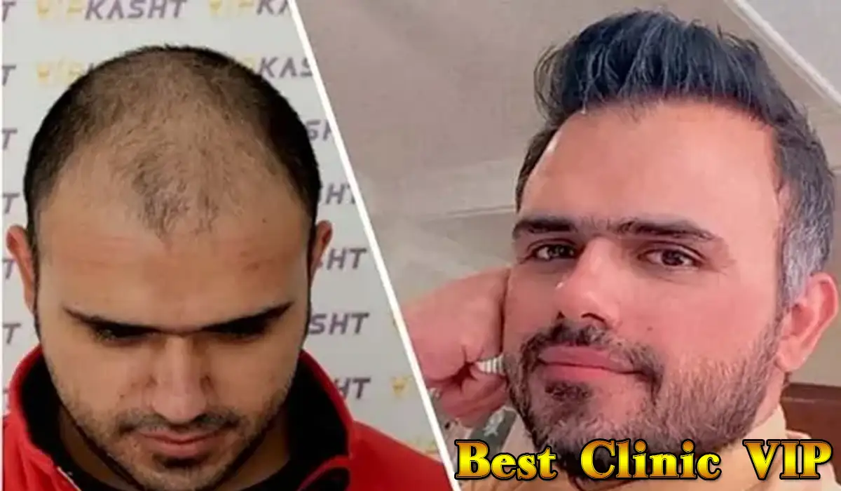  A hair transplant can be an effective