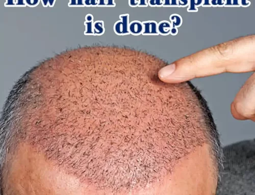 How hair transplant is done?