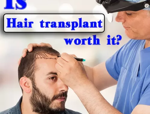 Is hair transplant worth it?