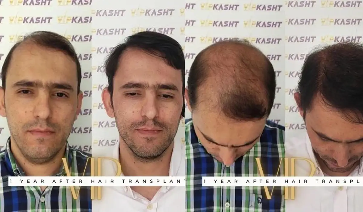 Prepare to Renew Your Hair with Before Hair Transplantation Tips!