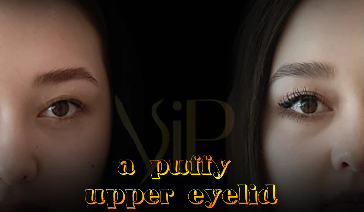 a puffy upper eyelid