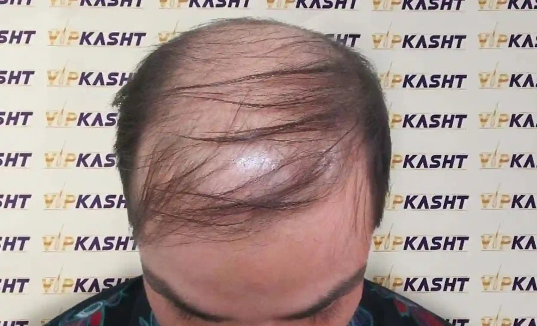 Hair transplants Before and After