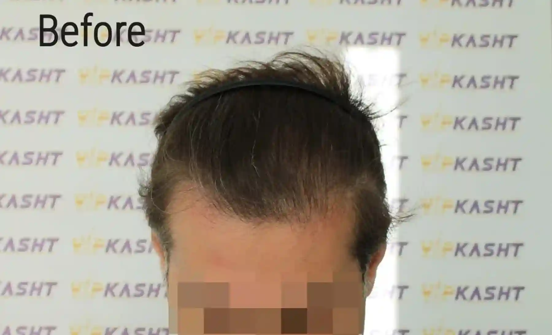 Hair transplants Before and After