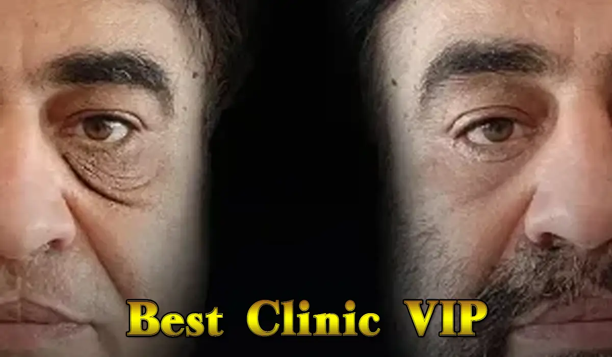 common problems related to Blepharoplasty
