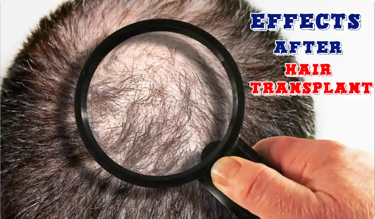effect after hair transplant