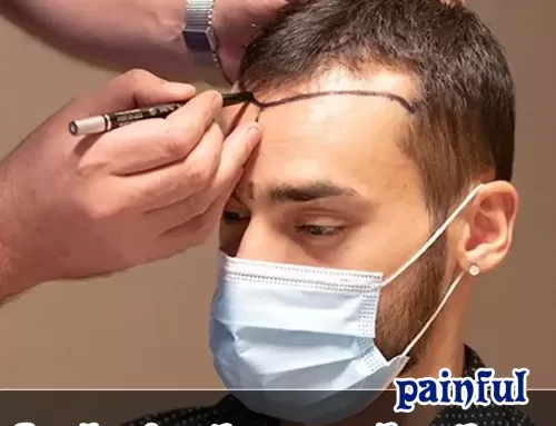 is hair transplant painful- Unveiling the Truth about Hair Transplant Pain