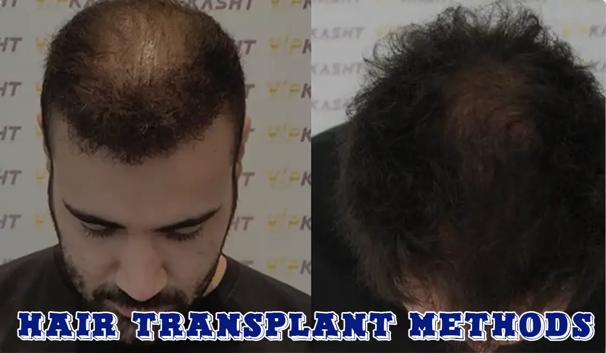 hair transplant methods