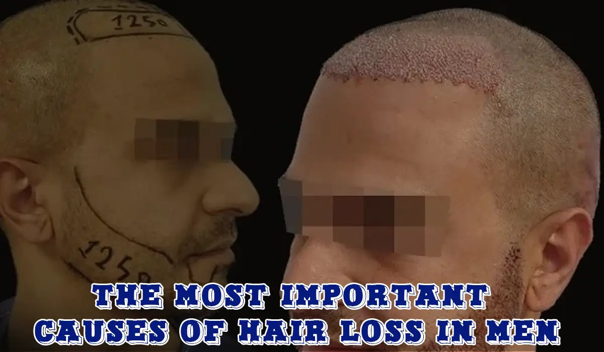 the most important causes of hair loss in men