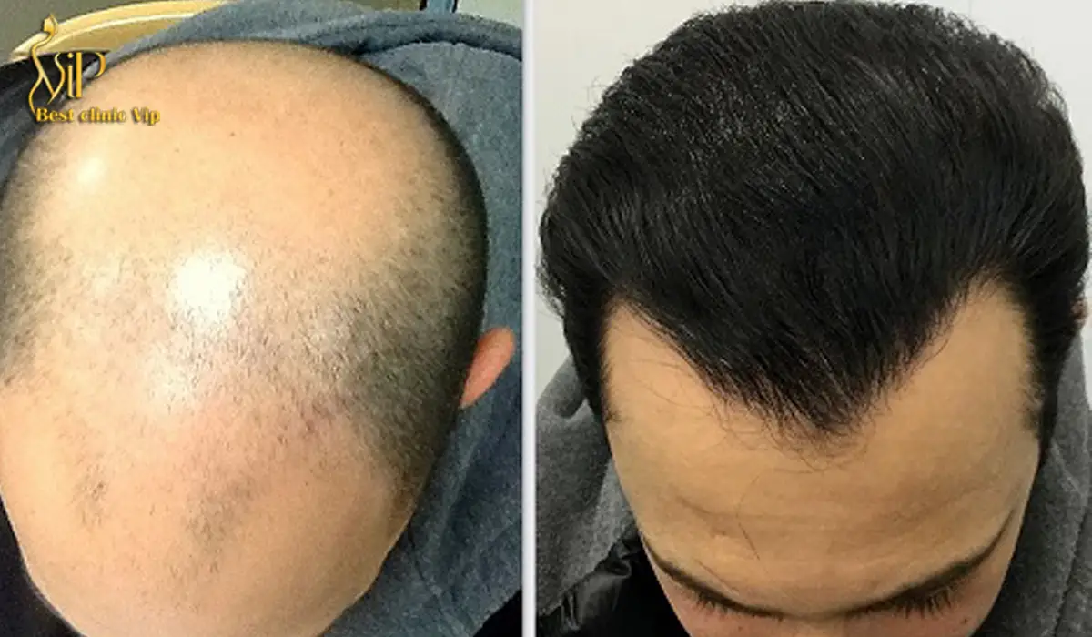 treating hair loss in men