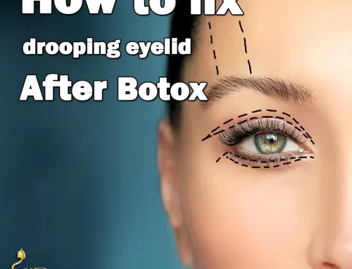 How to fix drooping eyelids after Botox?