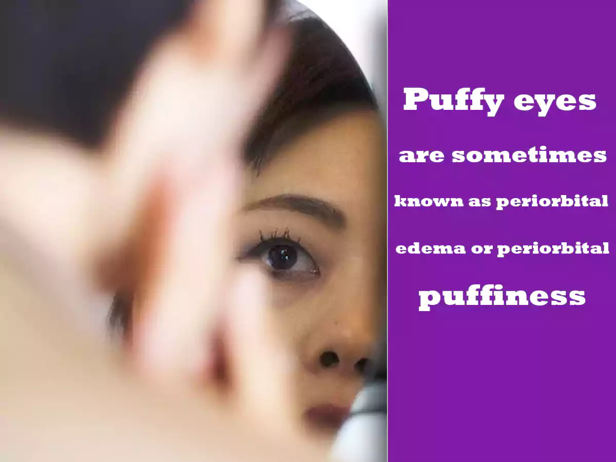 Puffy eyes are sometimes known as periorbital