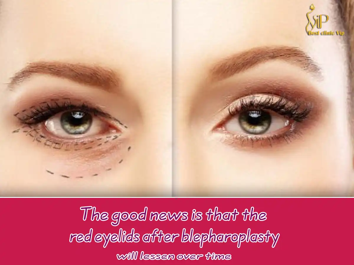 The good news is that the red eyelids after blepharoplasty will lessen over time
