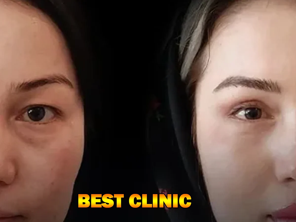 blepharoplasty in the top section