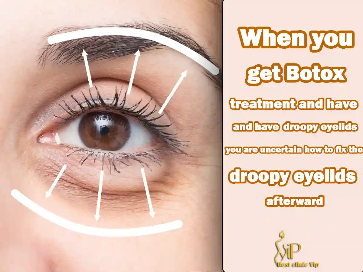 When you get Botox treatment and have droopy eyelids, you are uncertain how to fix the droopy eyelids afterward.