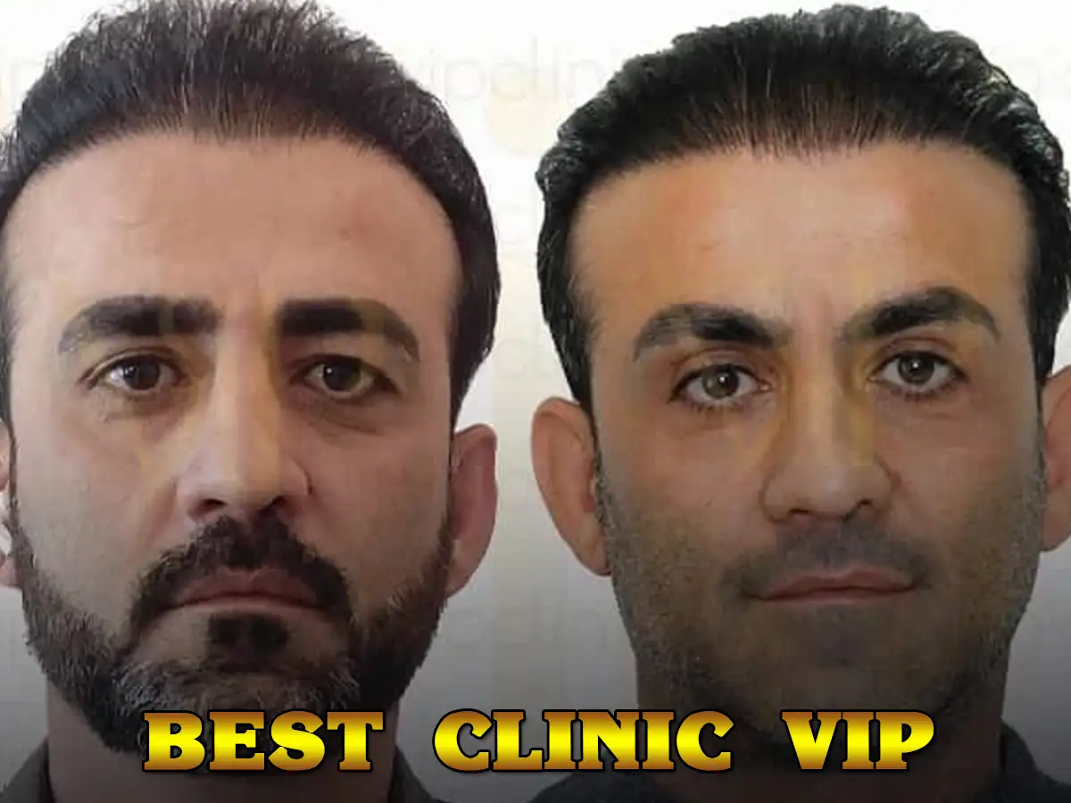 good candidate for a blepharoplasty operation