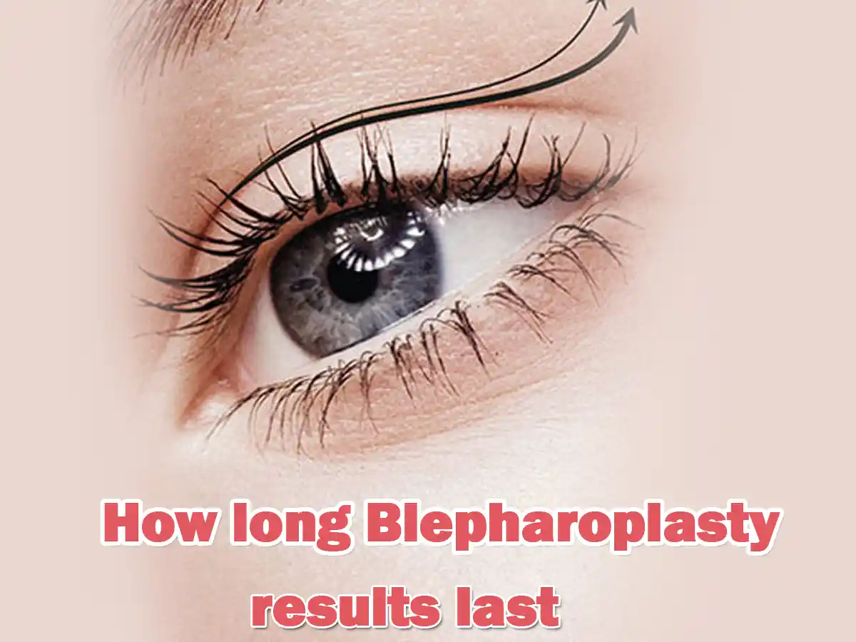 how long blepharoplasty results last
