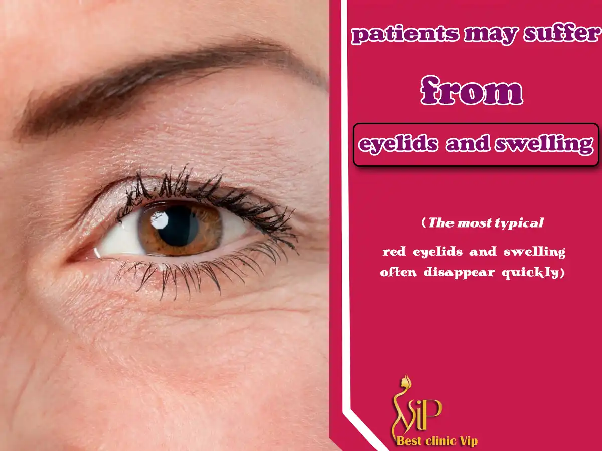 patients may suffer from red eyelids and swelling