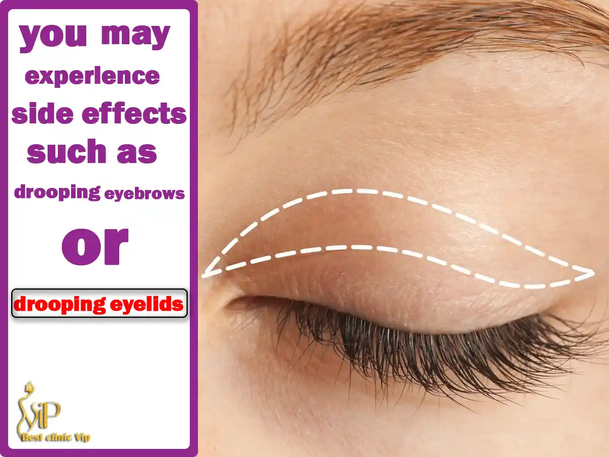 you may experience side effects such as drooping eyebrows or drooping eyelids