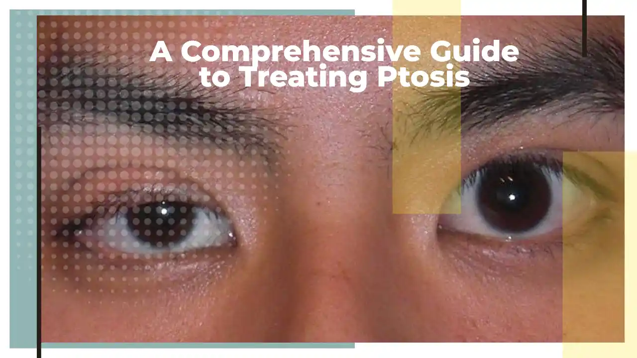 A Comprehensive Guide to Treating Ptosis