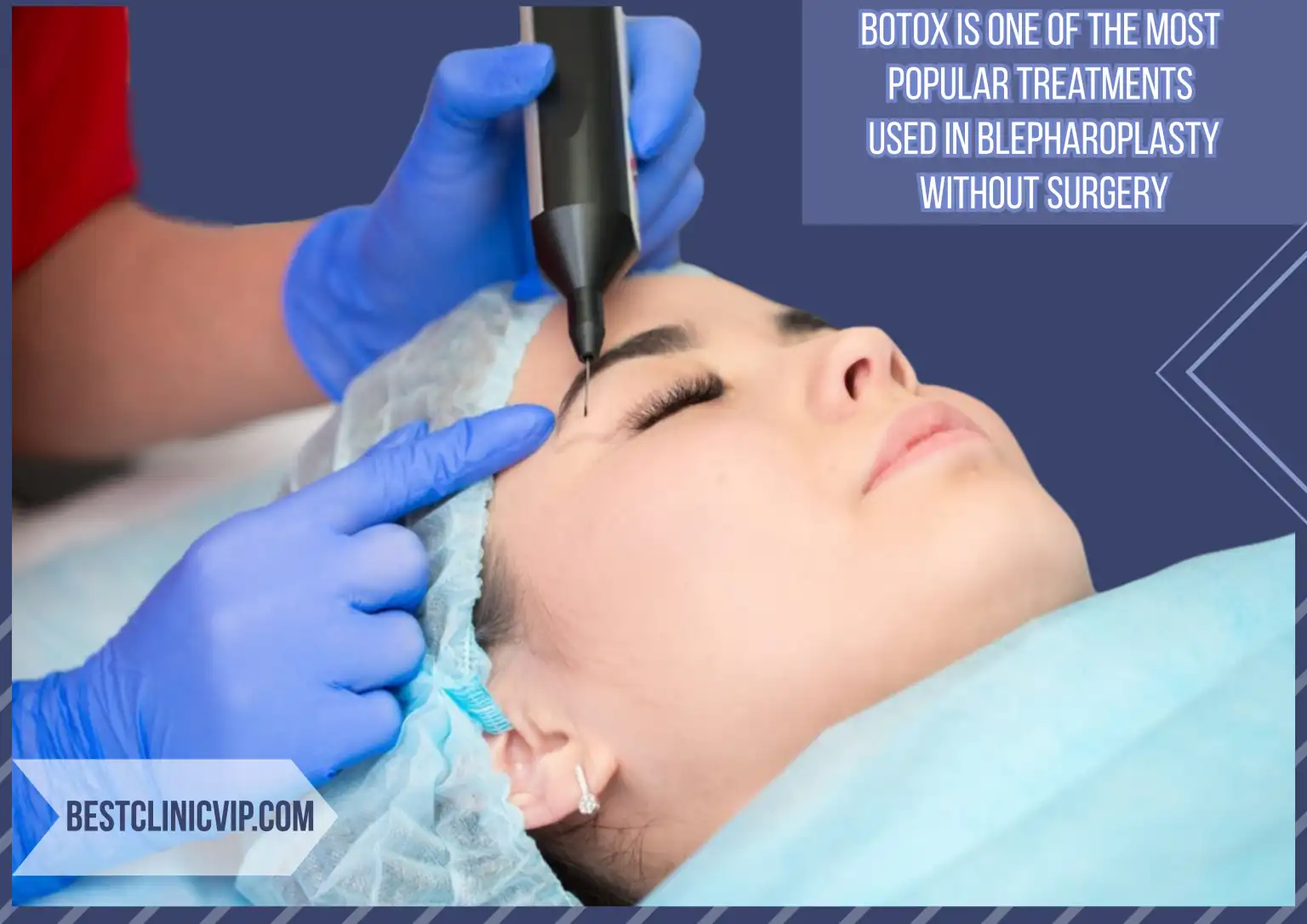 Botox is one of the most popular treatments used in blepharoplasty without surgery