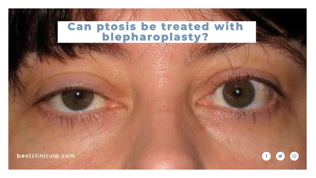 Can ptosis be treated with blepharoplasty?