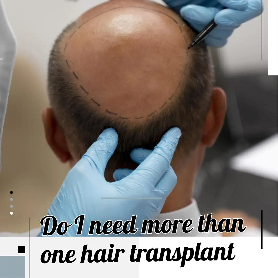 Do I need more than one hair transplant?