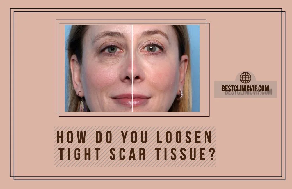 How do you loosen tight scar tissue?