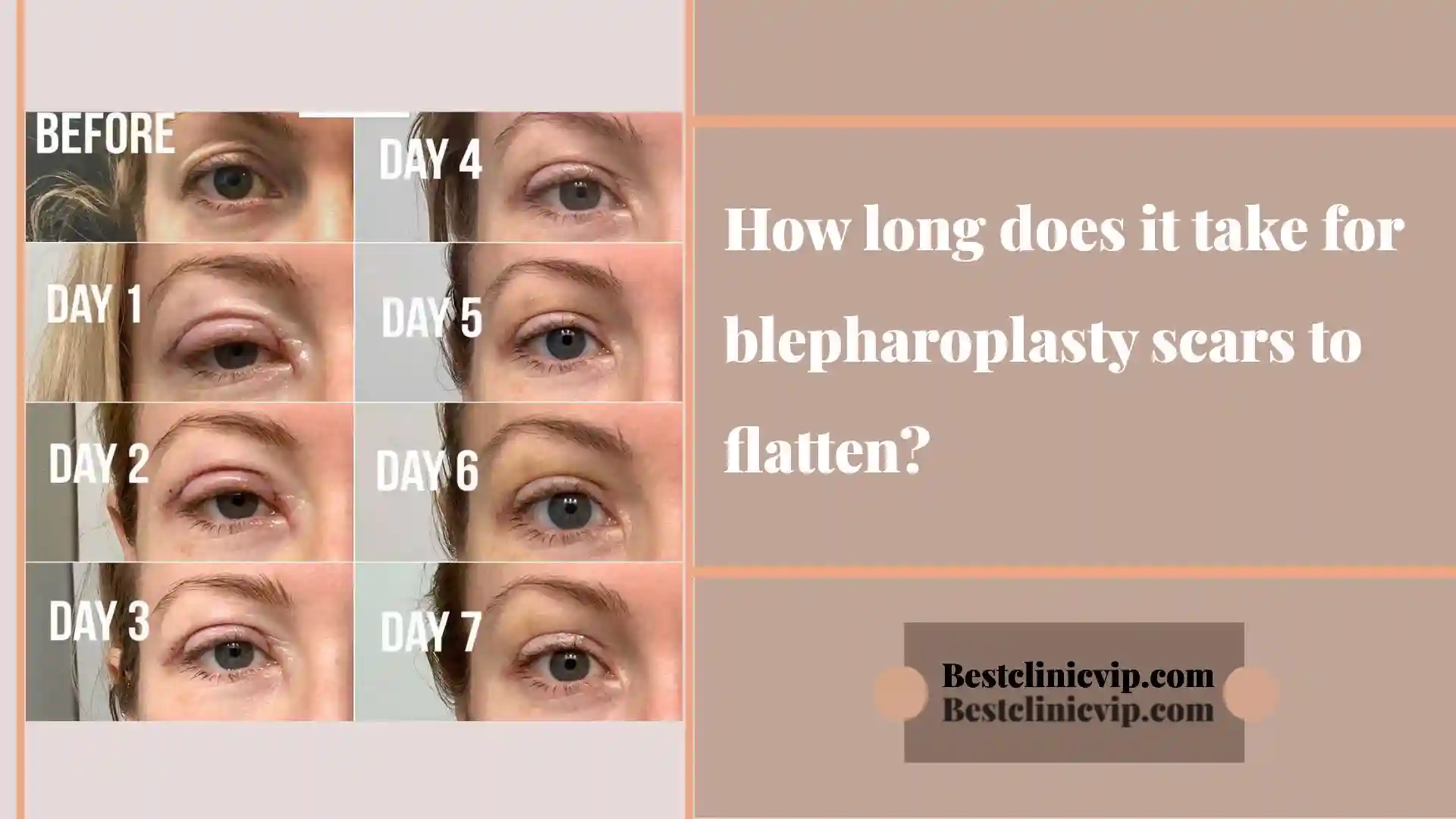 How long does it take for blepharoplasty scars to flatten?