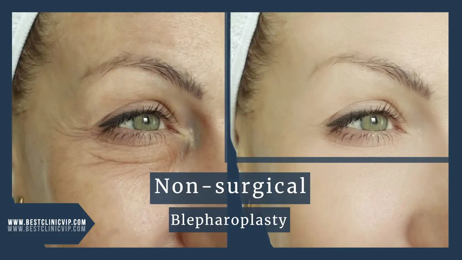 Non-surgical blepharoplasty