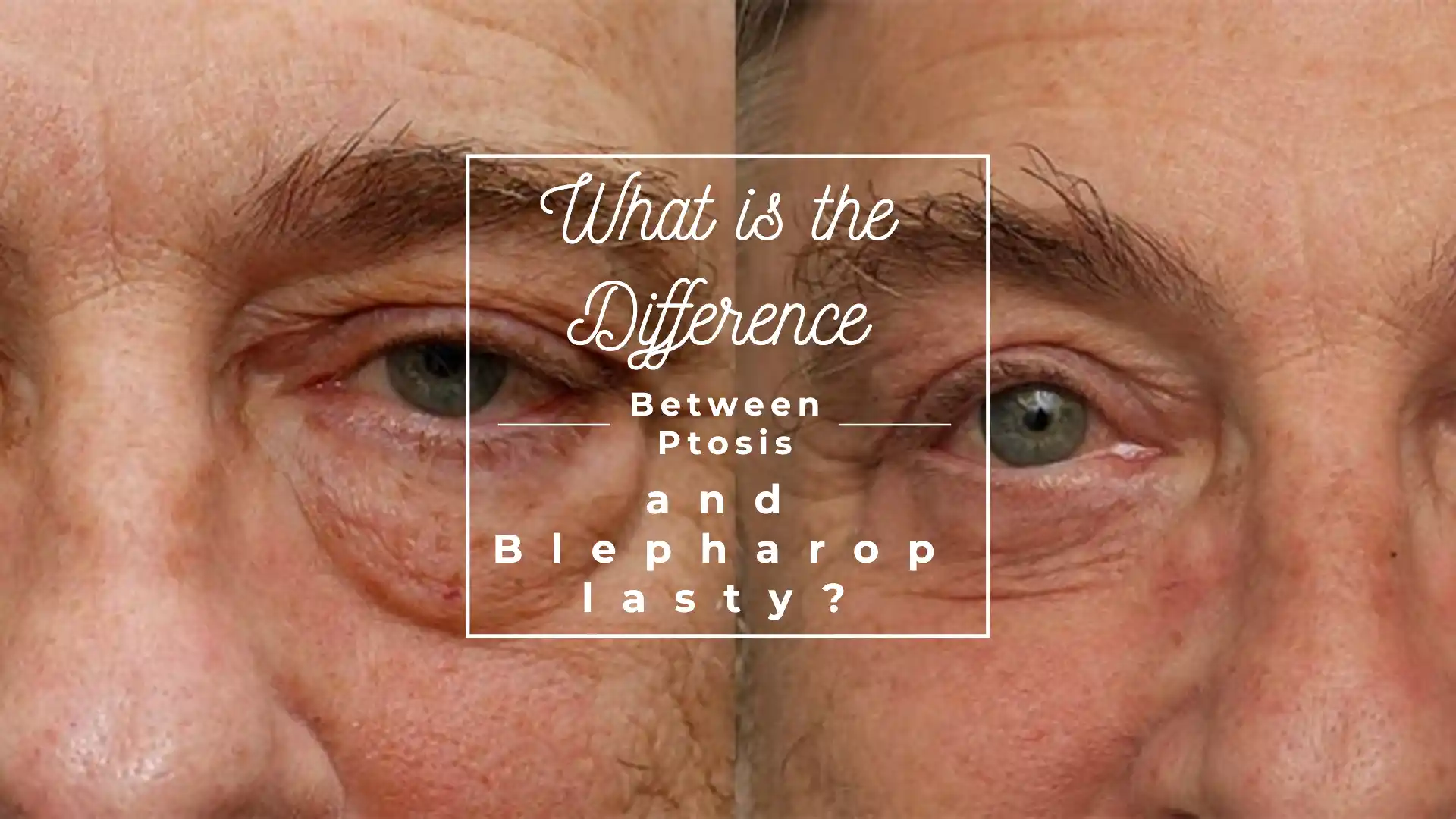 What is the Difference Between Ptosis and Blepharoplasty?
