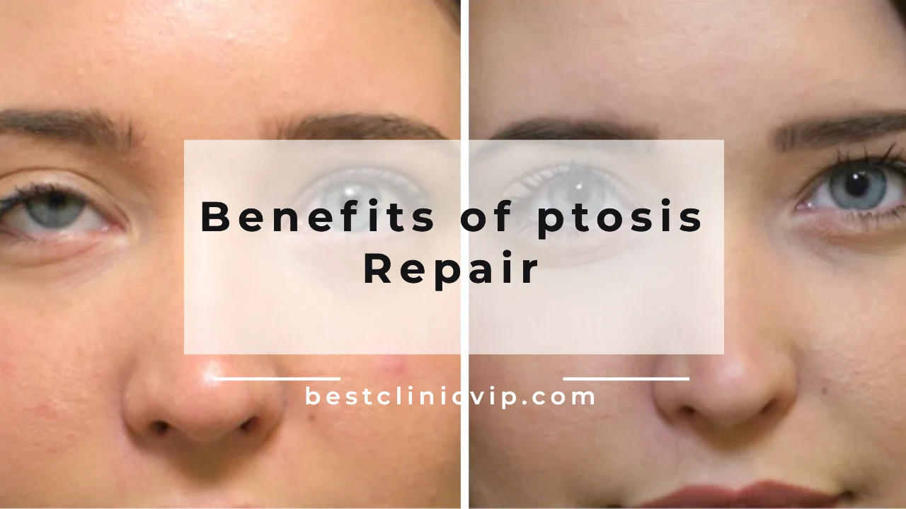 benefits of ptosis Repair