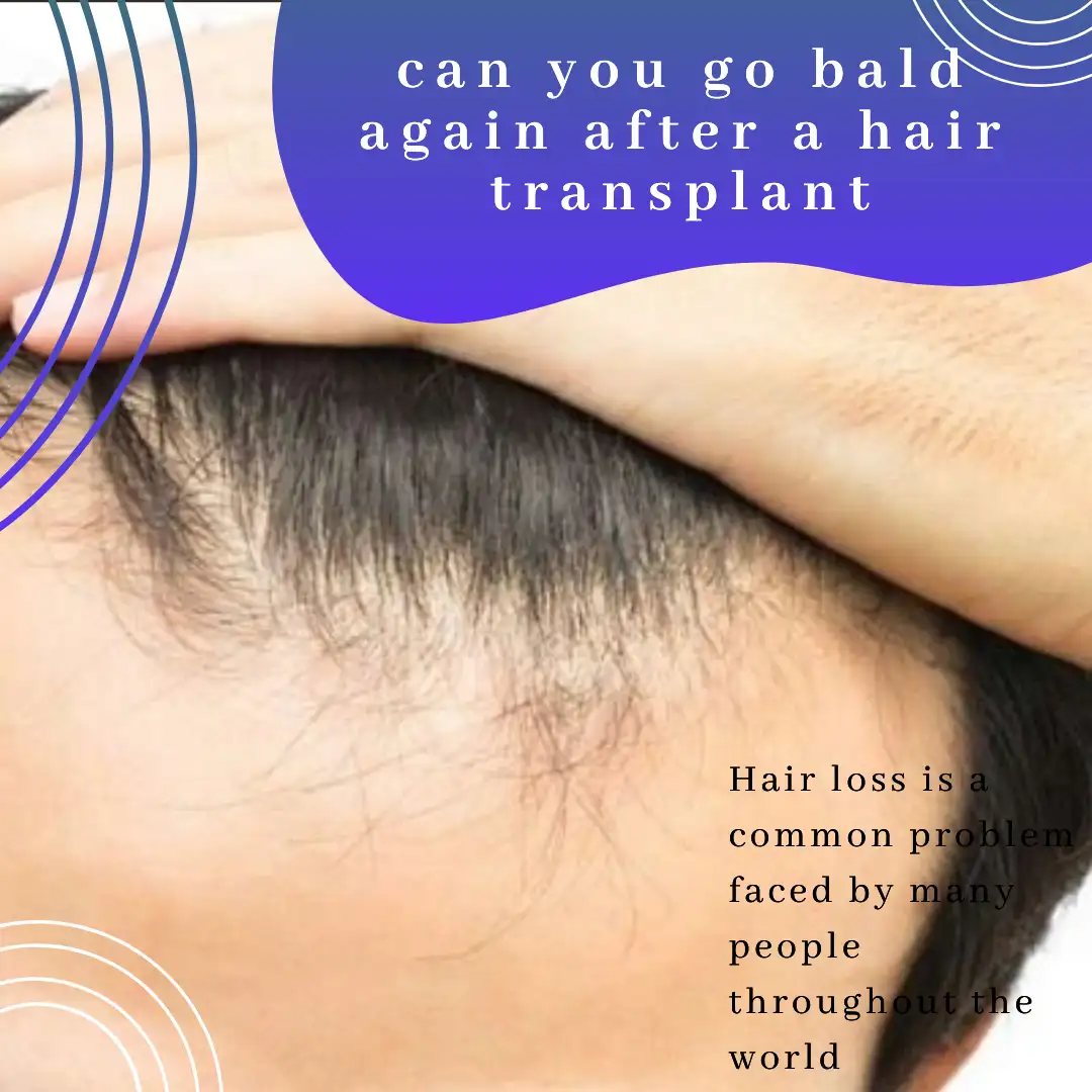 can you go bald again after a hair transplant