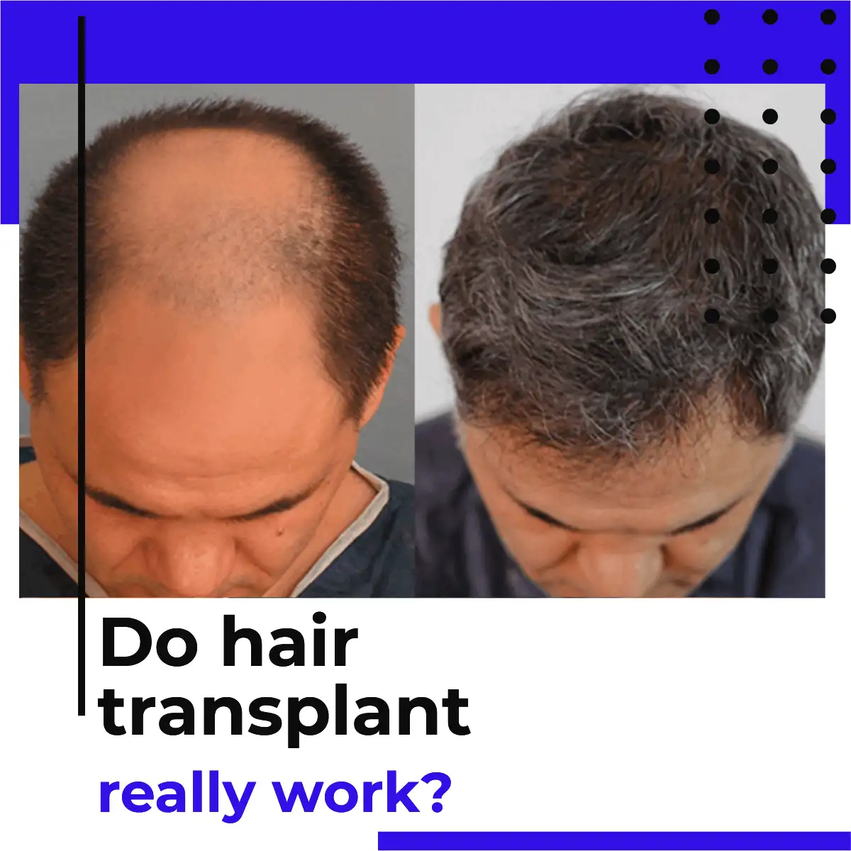 do hair transplants really work?
