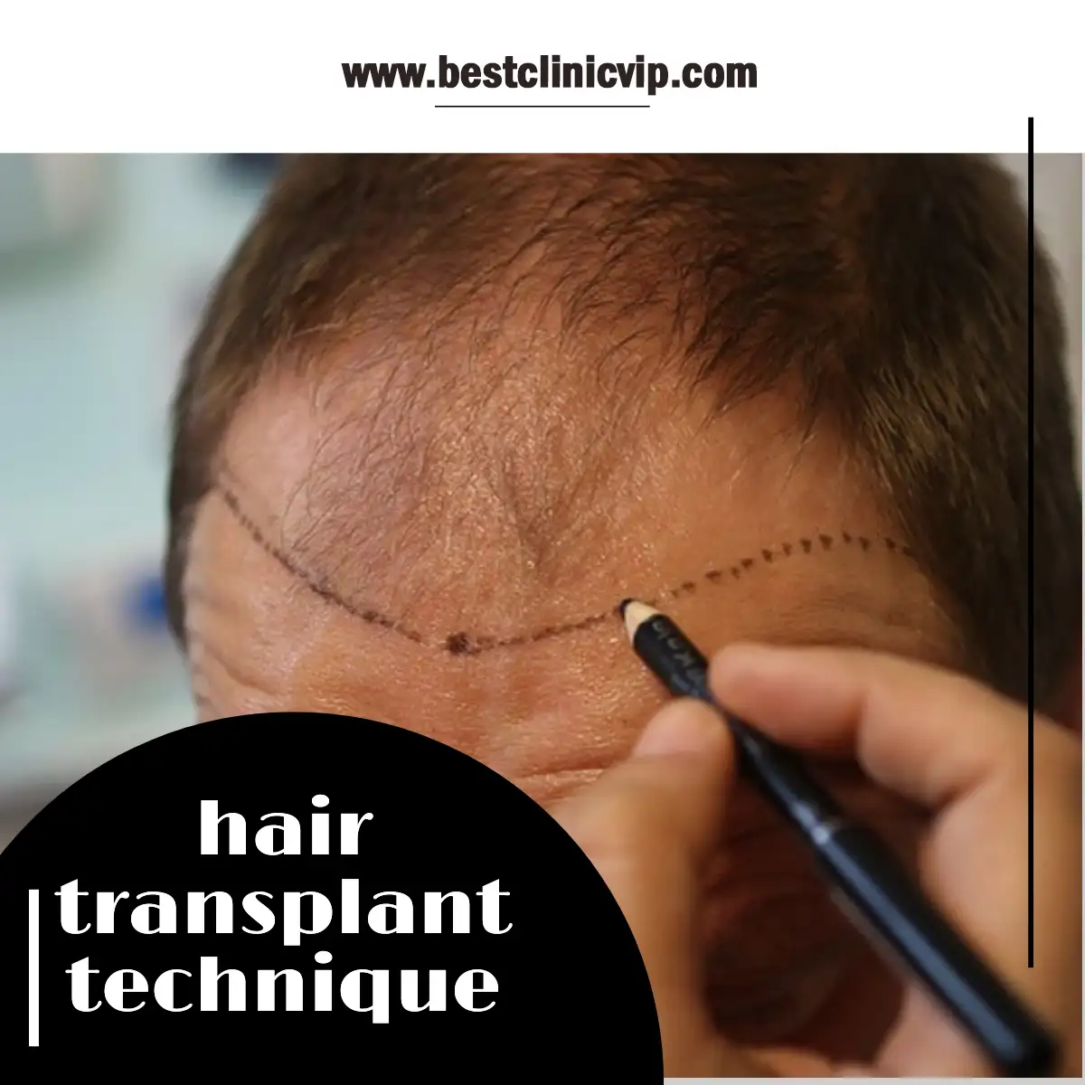 hair transplant technique