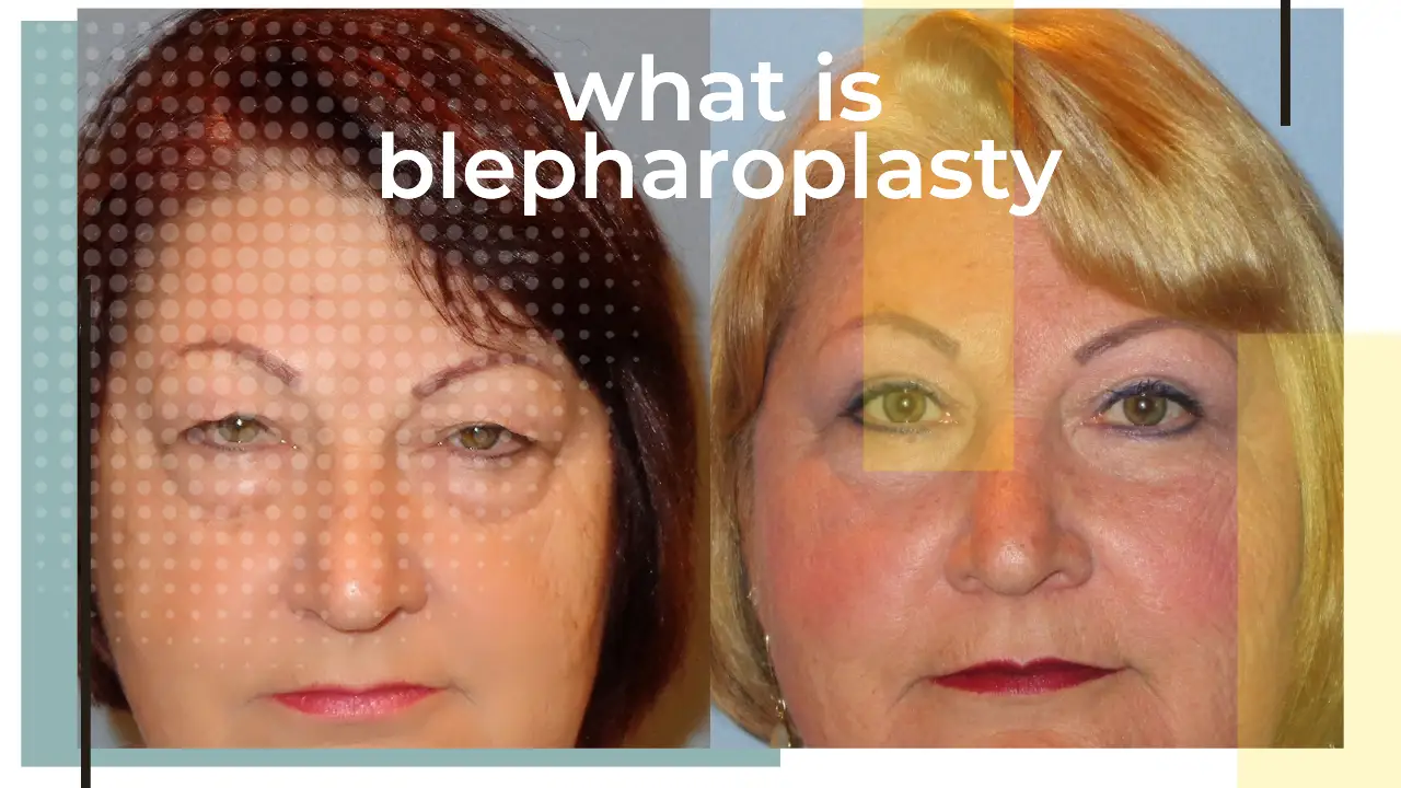 what is blepharoplasty