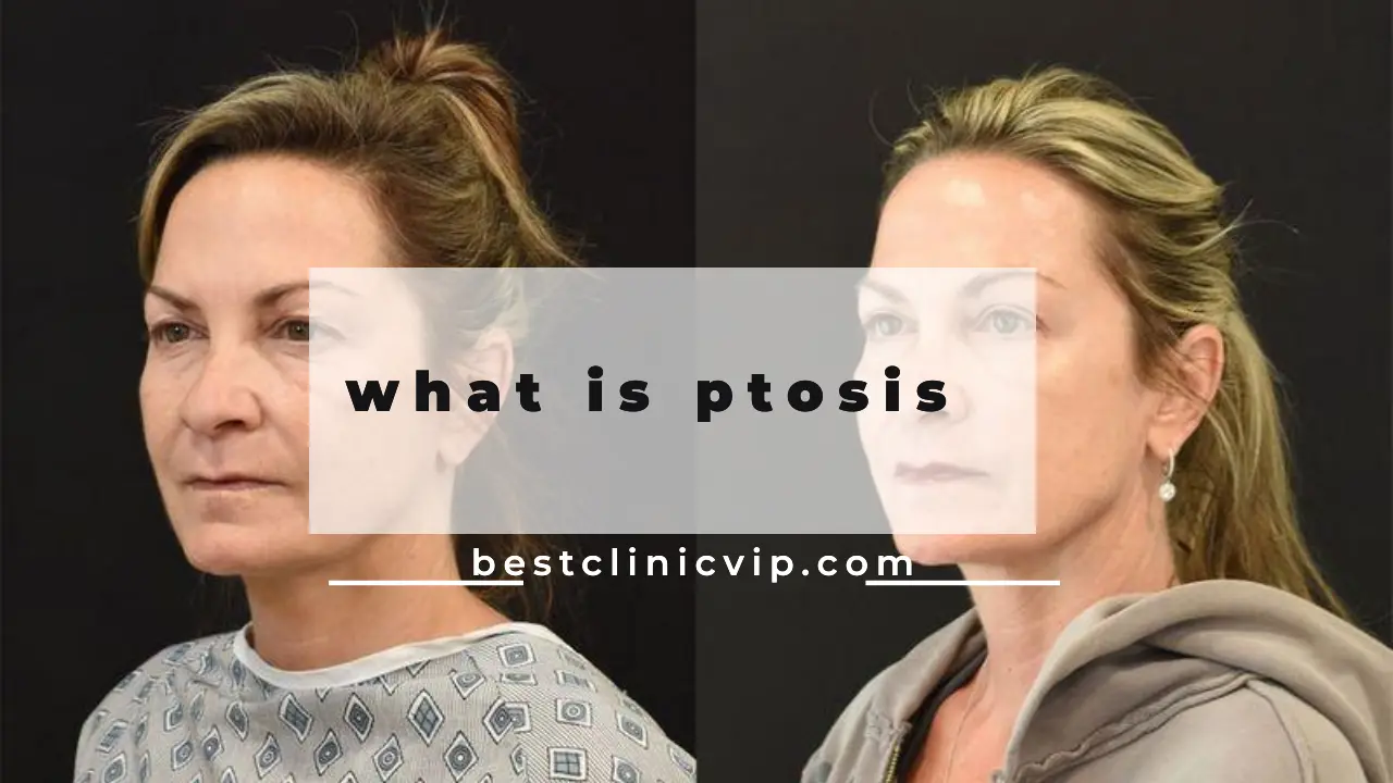 what is ptosis